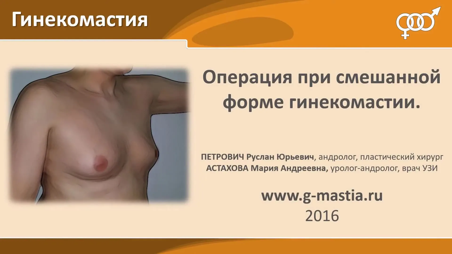 Операция при гинекомастии
