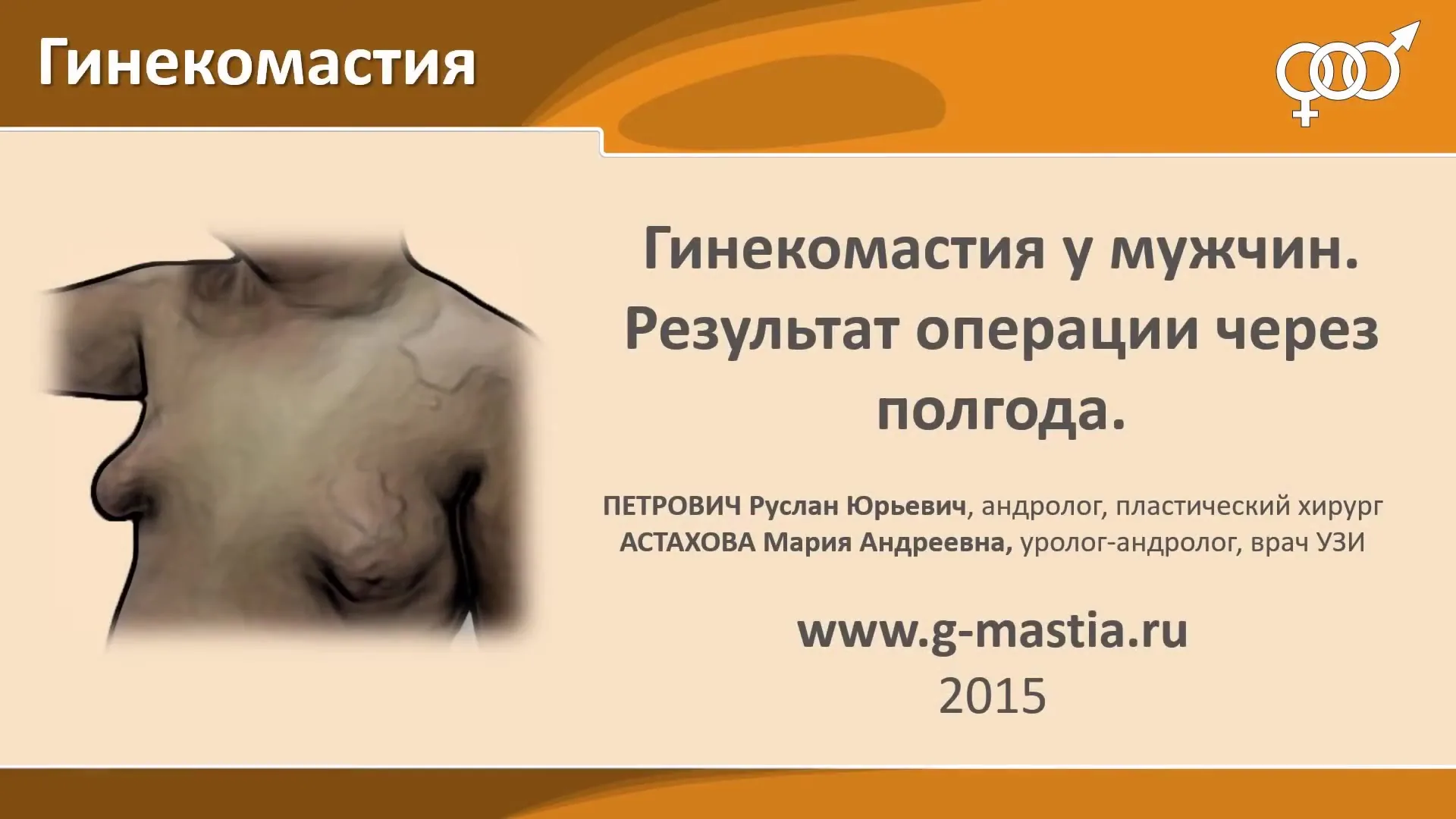 Удаление гинекомастии